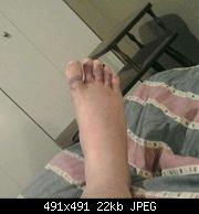 Sprained Foot 3